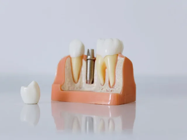 Modèle d'implant dentaire en titane avec couronne