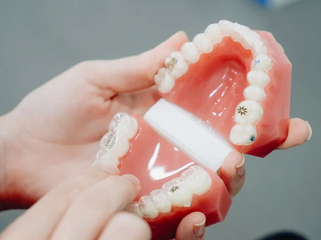 Modèle orthodontique avec appareil dentaire